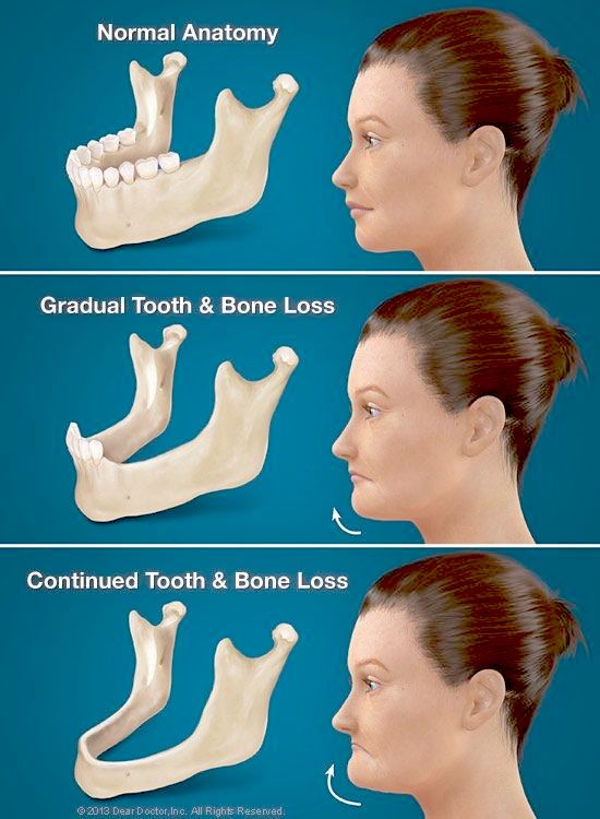 Cross-section showing jawbone resorption following tooth loss